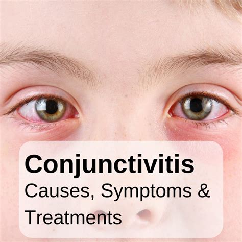 Trust the Expert: Get a Professional Diagnosis for Conjunctivitis